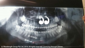 Three plates have been placed in Ryan's jaw.